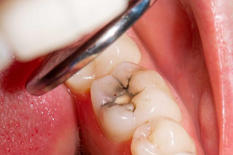 Zahnfüllung: Das Amalgam