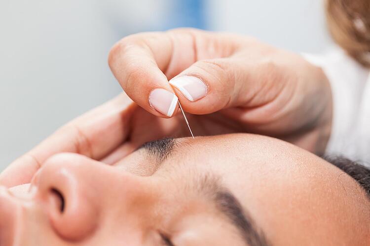 Akupunkturnadel auf der Stirn einer Frau