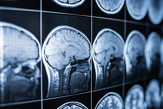 Was versteht man unter einer Gehirnerschütterung? 