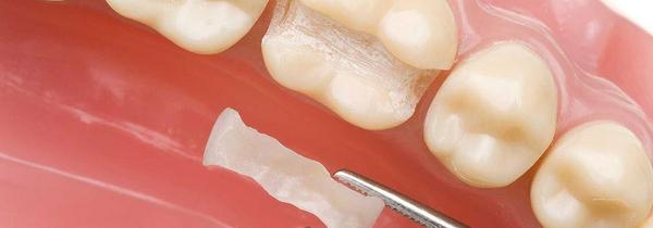 Keramik-Inlay für einen Backenzahn