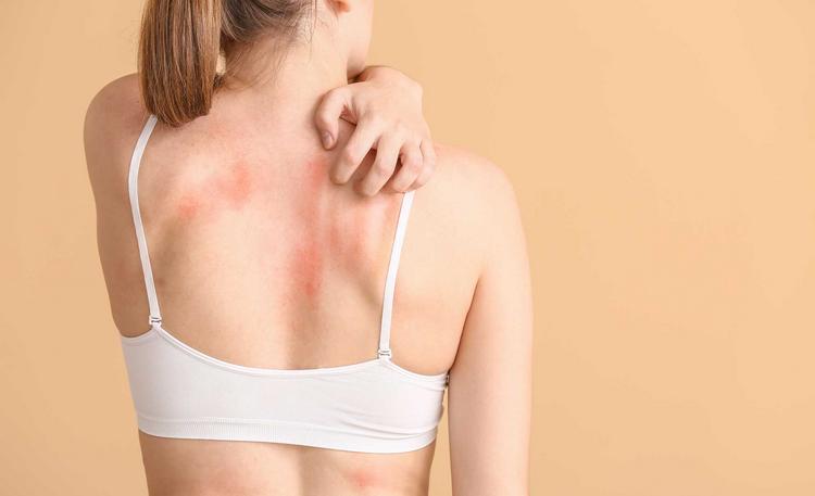Sonnenallergien: Wenn der Sommer Pusteln bringt