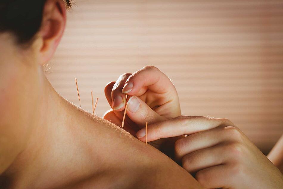 Frau steckt Akupunkturnadeln in die Schulter eines Mannes