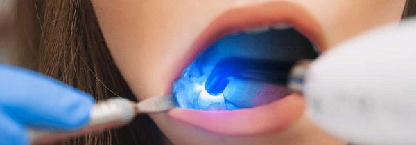 Patientin bekommt eine Zahnfüllung aus Kunststoff