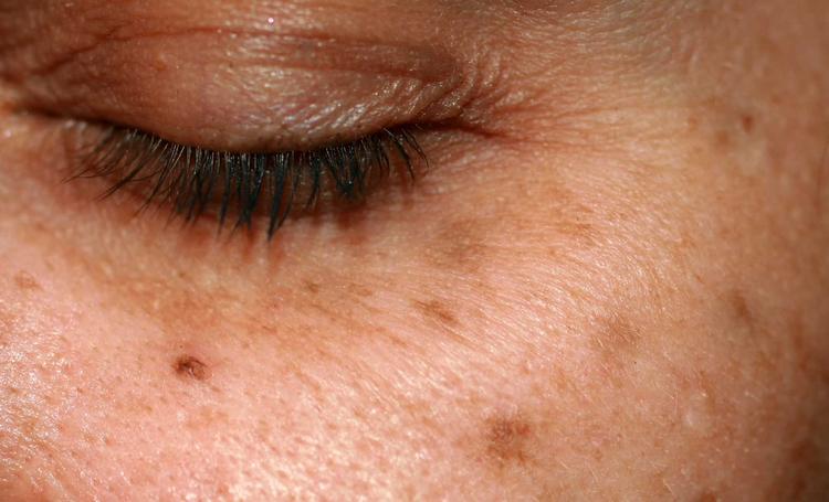 Altersflecken unter dem Auge einer Frau