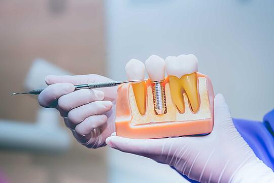 Zahnersatz: Das Zahnimplantat