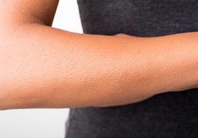 Weiblicher Arm mit Gänsehaut
