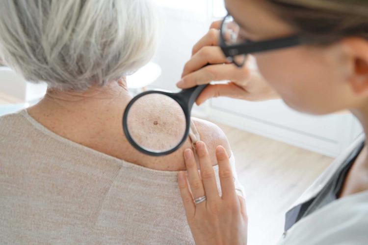 Hautkrebs – Krebsarten, Symptome, Vorsorge
