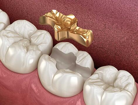 Zahnfüllung: Das Gold-Inlay