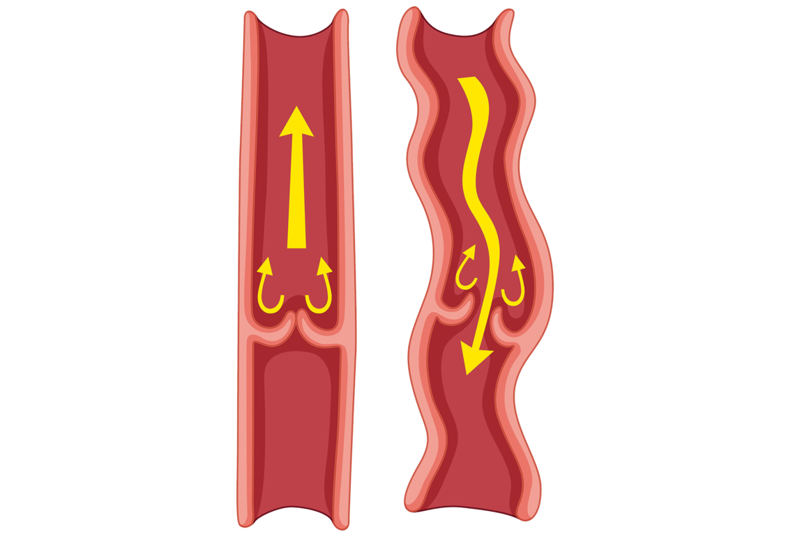 Bildnachweis: © istockphoto.com / colematt Illustration Krampfadern