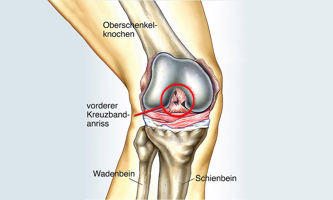 Illustration Bänderriss am Knie