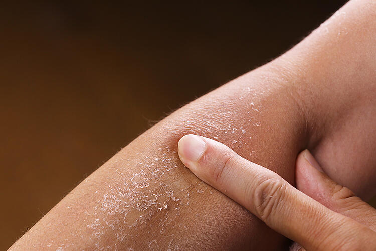 Am Arm einer Frau schält sich die Haut ab.