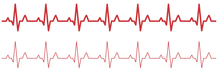 Was ist der Sinusrhythmus?