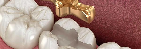 Illustration eines Gold-Inlays