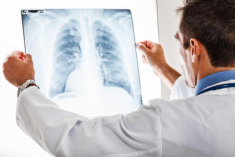 Arzt hält ein Röntgenbild von einer Lunge hoch