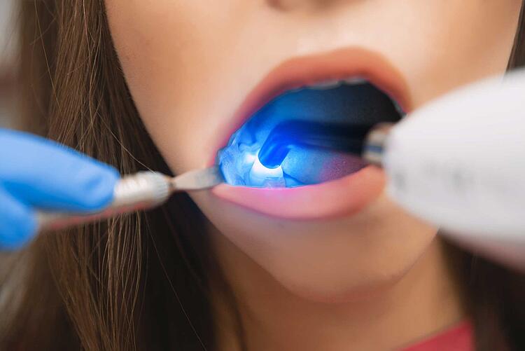 Patientin bekommt eine Zahnfüllung aus Kunststoff
