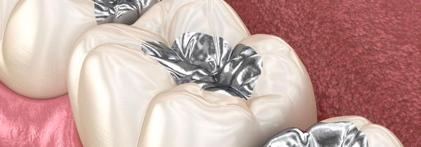 Modell einer Zahnfüllung mit Amalgam
