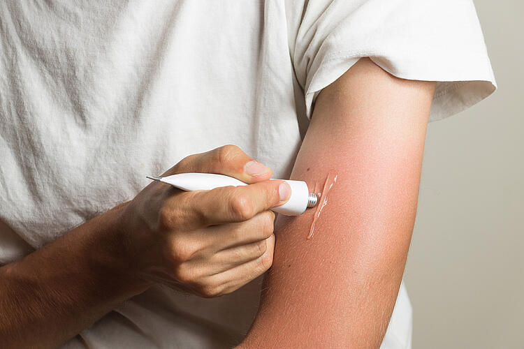 Kühlende Salbe auf einem Arm mit Sonnenbrand